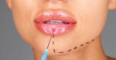 The Stages of Lip Filler Healing