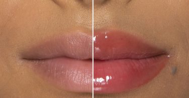Lip Filler Bruising Stages
