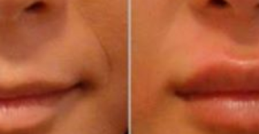 How Long Will Your Lips Be Swollen After Fillers