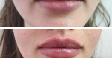 Swelling After Lip Fillers