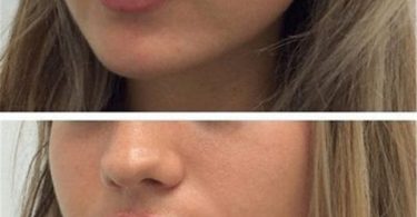 How Long Does Swelling Last in Lip Fillers