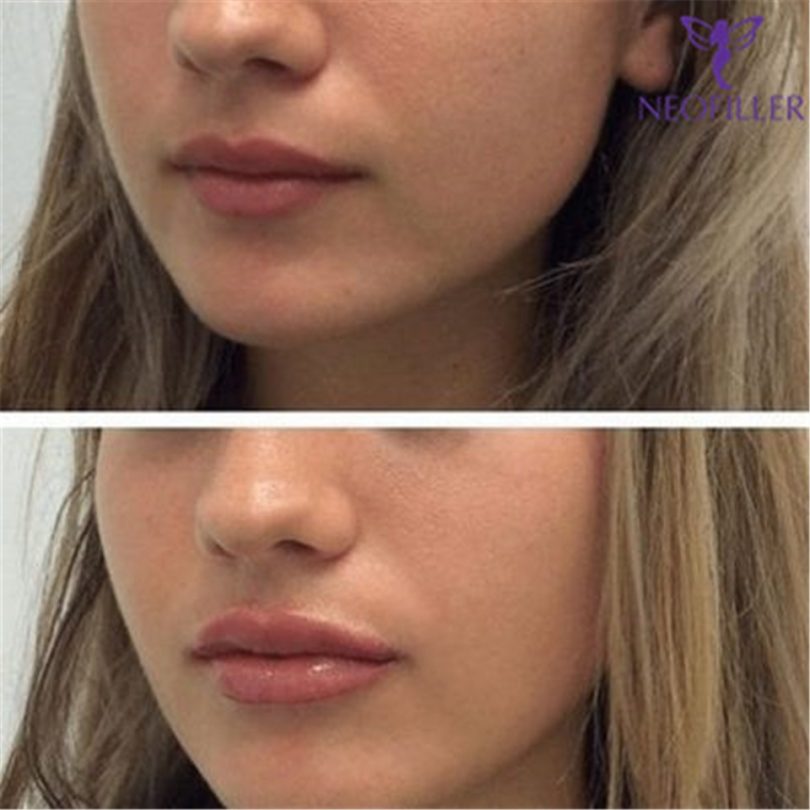 How Long Does Swelling Last In Lip Fillers Lip Fillers Swellings Stages
