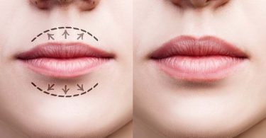 How Long Does Lip Swelling Last