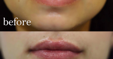 How Long For Swelling to Go Down After Lip Injections