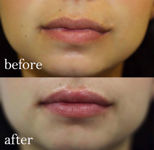 How Long For Swelling to Go Down After Lip Injections