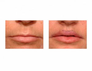 How Long For Swelling to Go Down After Lip Fillers