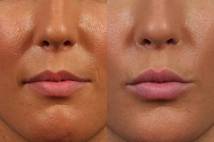 How Long For Swelling to Go Down After Lip Filler