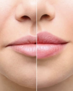How Long Does Swelling Last After Lip Fillers