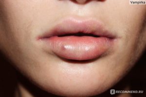 How Long Does Swelling Go Down After Lip Fillers