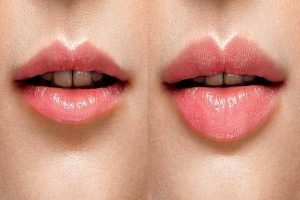 How Long Does Swelling From Lip Fillers Last