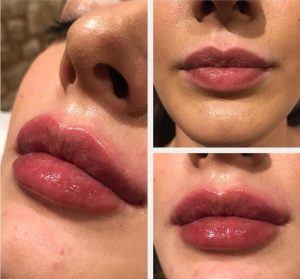 How Long Do Your Lips Stay Swollen After Injections