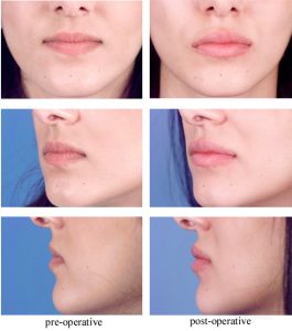 How Long Does Lip Swelling Last