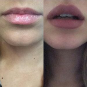 lips4How Long Do Lips Stay Swollen After Lip Injections