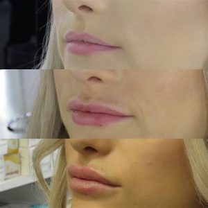 How Long Are Lips Swollen After Injections
