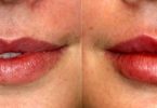 How Long Are Your Lips Swollen After Lip Filler