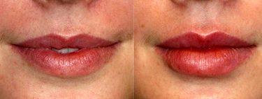 How Long Are Your Lips Swollen After Lip Filler